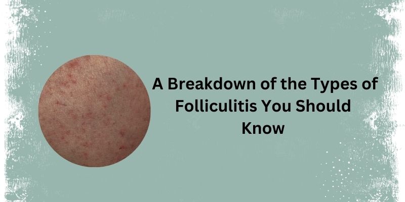 What are the types of Folliculitis, and how to prevent them? 