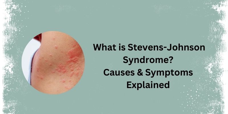 How to Identify and Treat Stevens-Johnson Syndrome? 